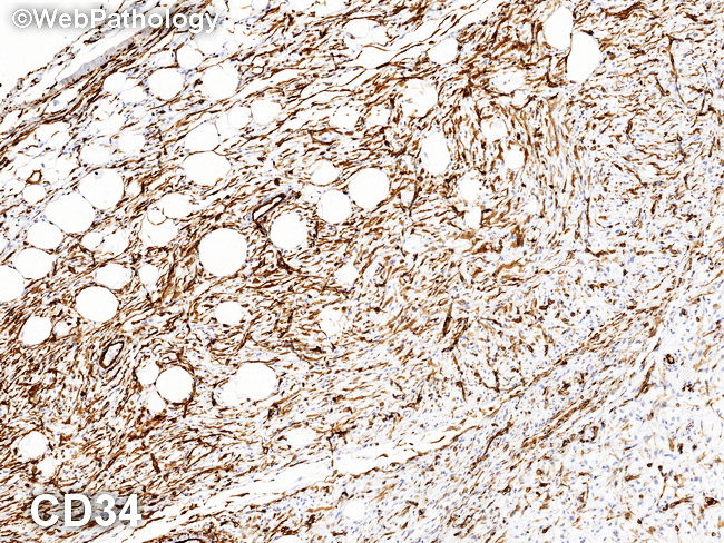 Soft Tissue_Lipomatous_Lipoblastoma37_CD34_resized.jpg